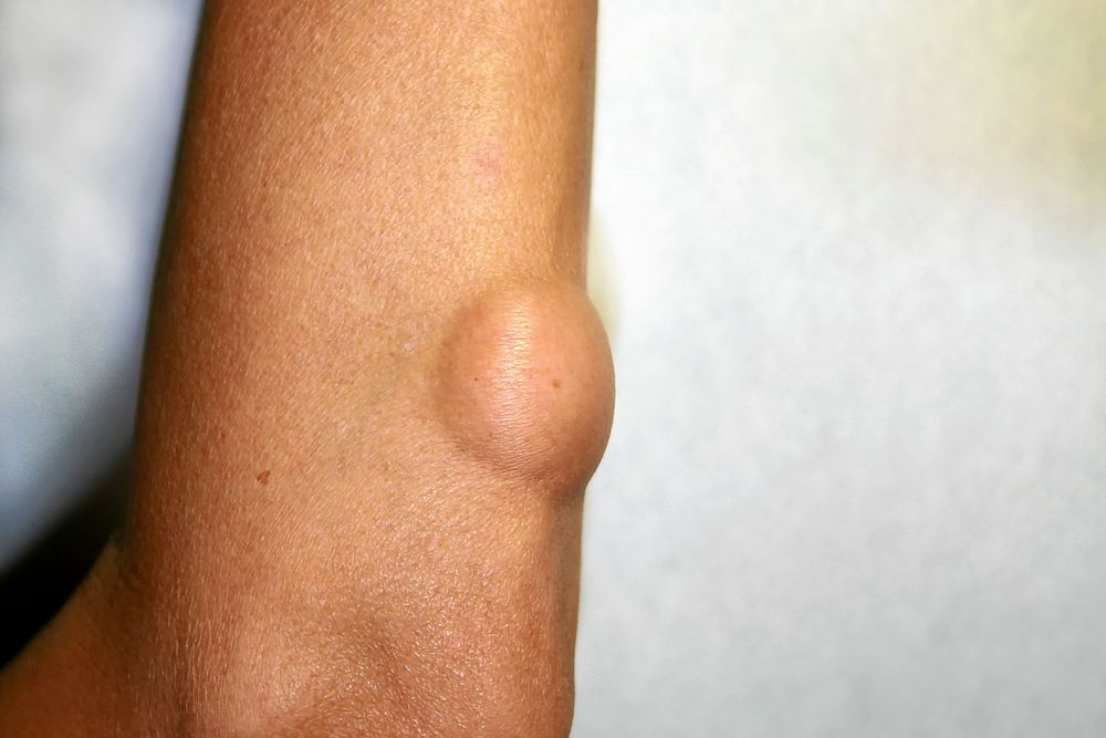 Att upptäcka en knöl på kroppen kan vara obehagligt men allt som oftast är de helt ofarliga, som detta lipom.