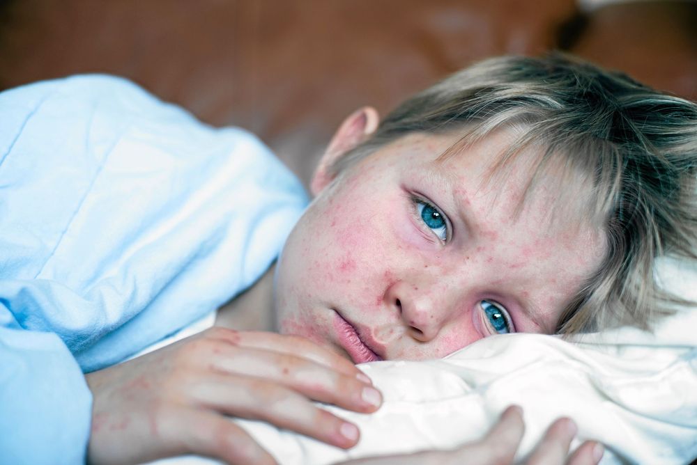Att få hög feber, bli väldigt medtagen och få röda utslag är typiskt vid mässling. 1 av 1000 smittade riskerar dessutom hjärninflammation.