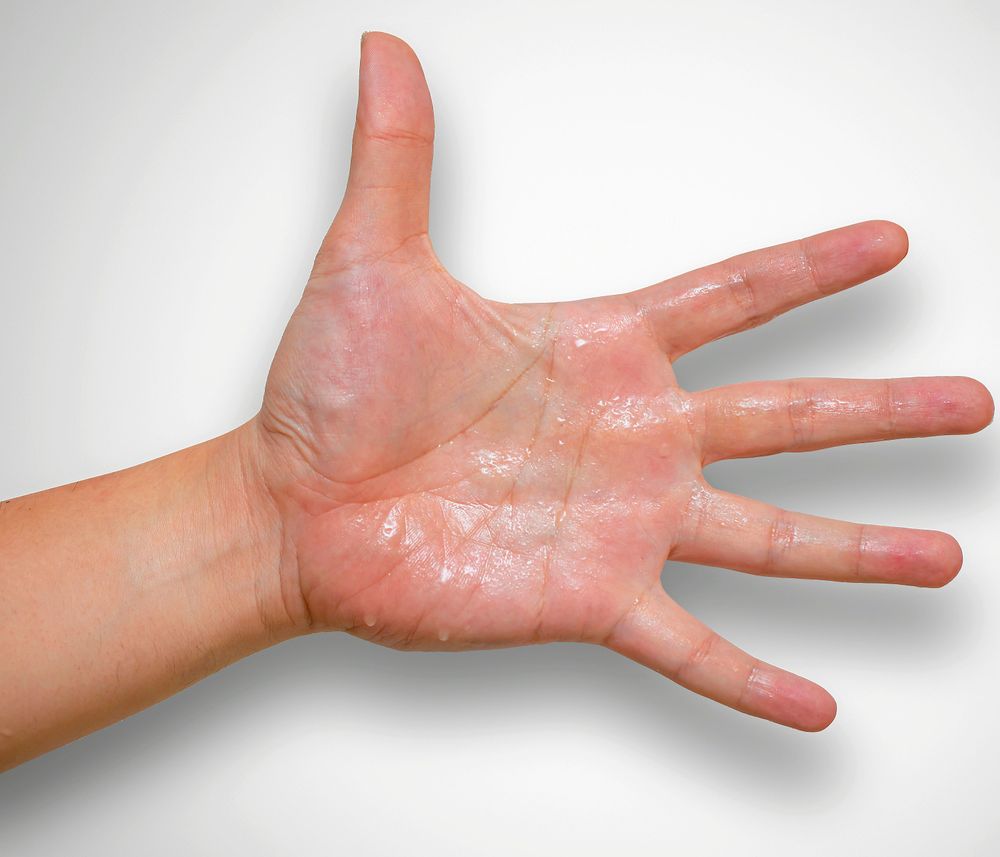 Det finns läkemedel, sprutor och andra behandlingar mot riklig handsvett – till exempel botox.